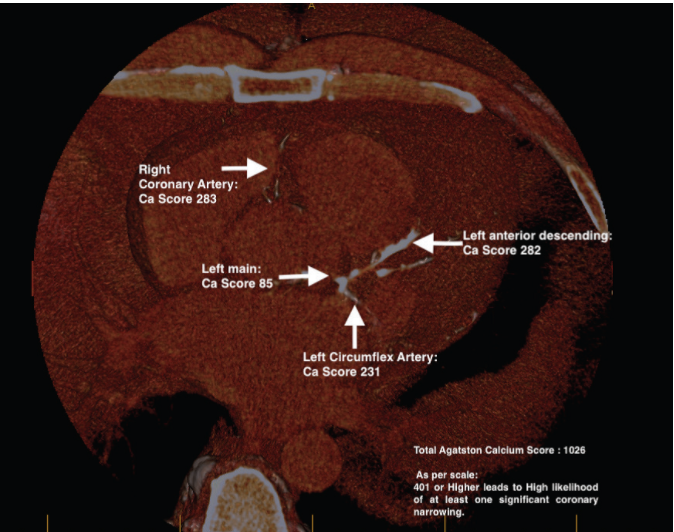 Heart Foundation gives calcium score the tick of approval IMED